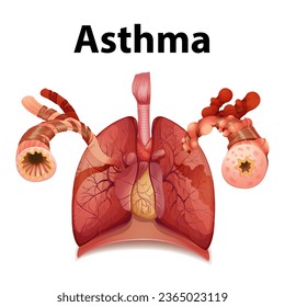 An informative infographic comparing normal and asthma lungs in a medical education context