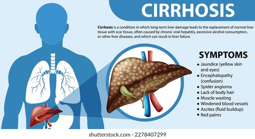 Informative poster of alcoholic liver disease Cirrhosis illustration