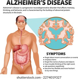 Informative poster of Alzheimers disease illustration