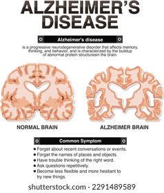 Informative poster of Alzheimers disease illustration