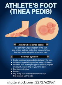 Informative poster of Athlete foot illustration