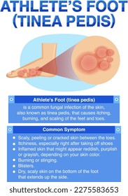 Informative poster of Athlete foot illustration