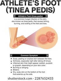 Informative poster of Athlete foot illustration