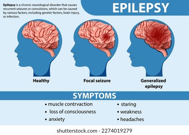 Informative poster of Epilepsy illustration