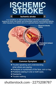 Informative poster of Ischemic stroke illustration