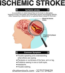 Informative poster of Ischemic stroke illustration