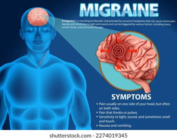 Informative poster of Migraine illustration