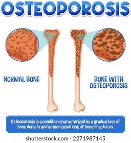 Informatives Poster von Osteoporose menschliche Knochengrafik
