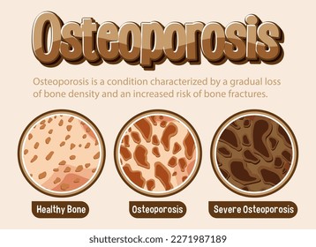 Informative poster of Osteoporosis human bone illustration