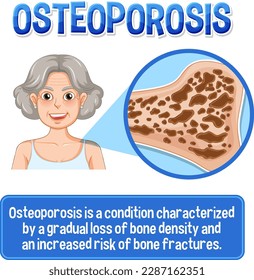 Informative poster of Osteoporosis human bone illustration