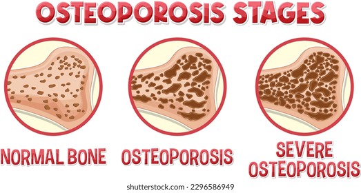 Informative poster of Osteoporosis human bone illustration