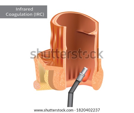 Infrared Coagulation Therapy IRC for Hemorrhoids Treatment