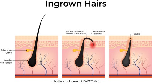 Ingrowen Hairs Design Vector Illustration