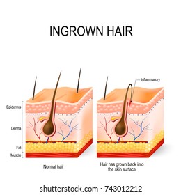 Ingrown hair after having. buried hair. structure of the hair follicle. razor bumps