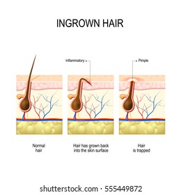 Ingrown Hair After Hair Removal Shaving Stock Vector (Royalty Free ...