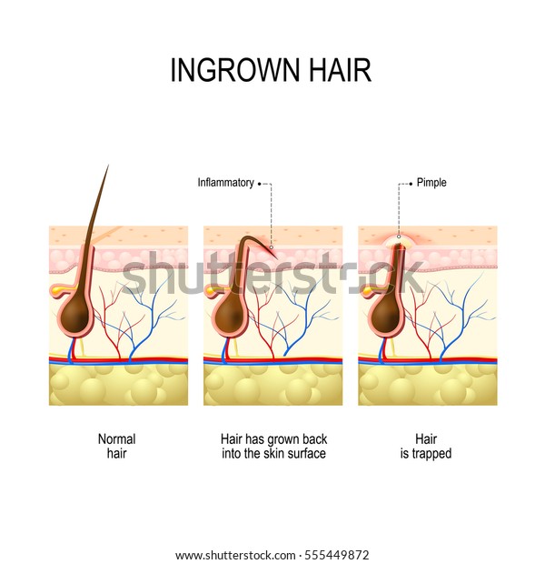 Ingrown Hair After Hair Removal Shaving Stock Vector Royalty Free