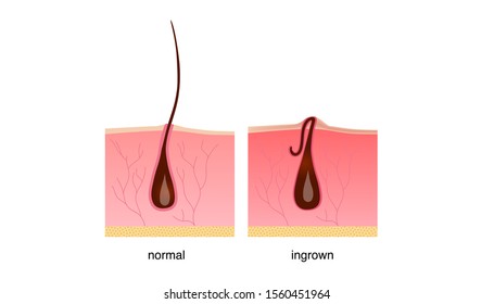 Ingrown hair after shaving, cream or epilator. Anatomy infographics of hair vector illustration. Beautiful legs.