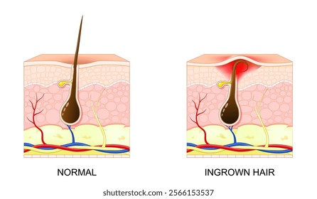 Ingrown hair. Hair follicle entrapment. Shaving irritation. Comparison and difference between Normal skin and Inflamed follicle. Vector poster. Illustration in flat style. 