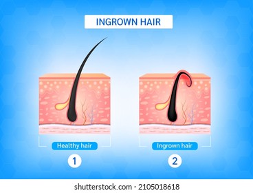 Ingrown hair. Hair has grown back into the skin surface after shaving. Formation of skin acne or pimple. Anatomy infographics of hair and skin. 3D vector illustration.