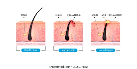 Cabello cultivado. El pelo ha vuelto a crecer en la superficie de la piel después de afeitarse. Formación de acné o pimienta cutáneo. infografía anatómica de pelo y piel. Sobre un fondo blanco. Ilustración vectorial 3D.