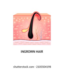 Ingrown hair. Hair has grown back into the skin surface after shaving. Formation of skin acne or pimple. Anatomy infographics of hair and skin. On a white background. 3D vector illustration.