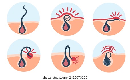 Ingrown hair. Hair has grown back into the skin surface after shaving. Inflamed follicle. Shaving concept. Vector illustration with problems after depilation.