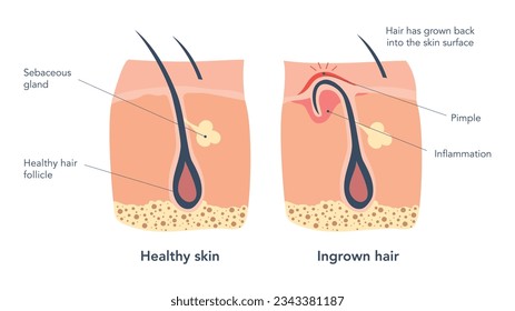 Ingrown hair and normal hair medical schemes under microscope. Ingrown hair leads to the redness and inflammation, that associated also with pimples and blocked pores. Vector illustration