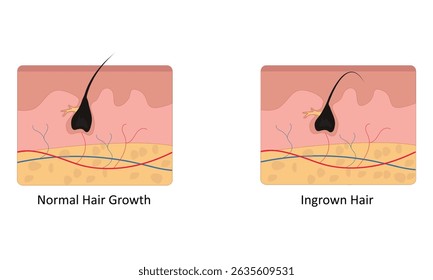 Cabelo encravado na ilustração do vetor de pele	