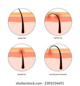 Ingrown hair poster. Hair starts to grow back and curves into the skin. Painful fillings and inflammation in the skin. Skin layers diagram, epidermis and dermis medical poster flat vector illustration svg