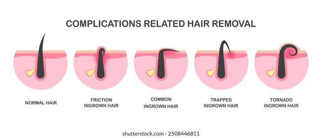 Ingrown hair, problems after hair removal, complications after epilation or depilation. Complications related hair removal.