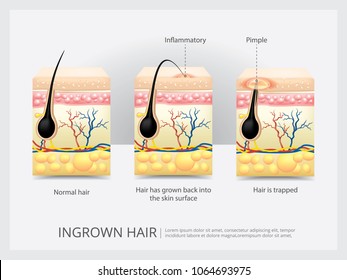 Ingrown Hair Structure Vector Illustration