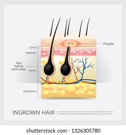 Hair Follicle Bacteria Temaju Kepek Stockfotok Es Vektorkepek