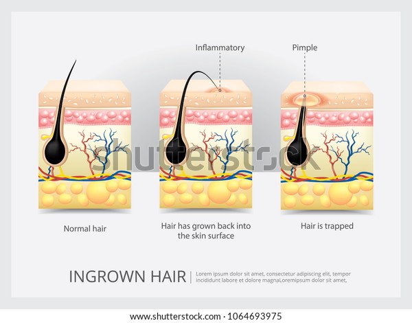 Ingrown Hair Structure Vector Illustration Stock Vector (Royalty Free ...