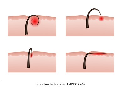 Ingrown Hair Images Stock Photos Vectors Shutterstock