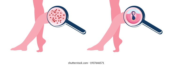 Ingrown hairs and strawberry legs infographic. Skin problems because of Wrong shaving or depilation.Comedones and clogged pores.Magnifier zooms inflammation follicle.Vector illustration in flat style