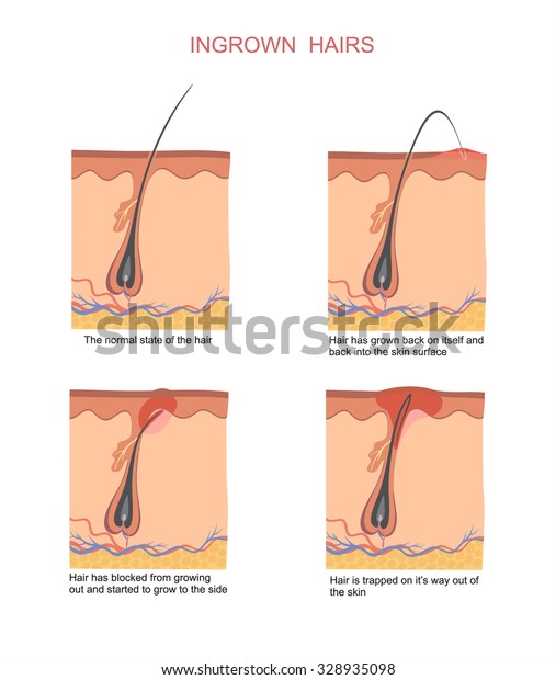 Ingrown Hairs When Shaving Depilation Stock Vector Royalty Free