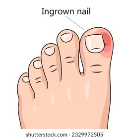 Ingrown nail onychocryptosis diagram schematic vector illustration. Medical science educational illustration