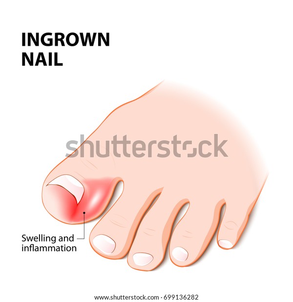 Ingrown Nail Onychocryptosis Nail Disease Stock Vector (Royalty Free ...