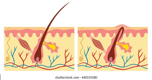 ingrown and normal hair (human skin anatomy illustration) 
