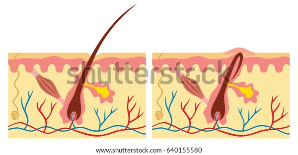 Ingrown Normal Hair Human Skin Anatomy Stock Vector (Royalty Free ...