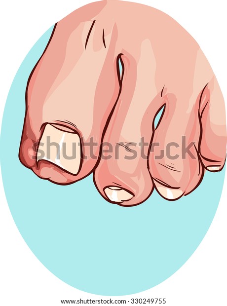 Ingrown Toenail Stock Vector (Royalty Free) 330249755 | Shutterstock