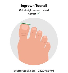 Doença da unha encravada, forma correta da unha	