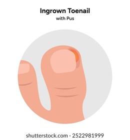 Ingrown toenail  disease, correct toenail form	