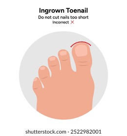 Ingrown toenail  disease, correct toenail form	