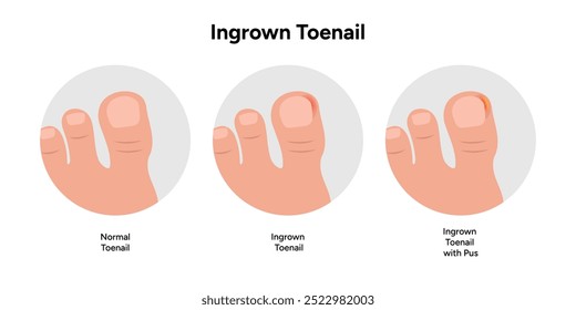 Ingrown toenail  disease, correct toenail form	