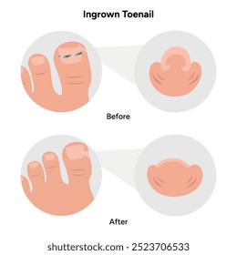 Ingrown toenail  disease or infection with pus	before and after