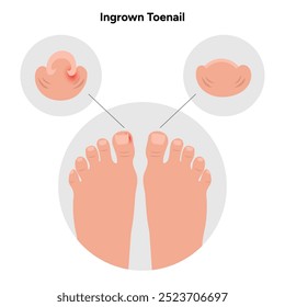 Ingrown toenail  disease or infection with pus	and healthy toenail 