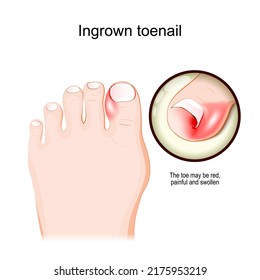 Ingrown Toenail Human Foot Closeup Red Stock Vector (Royalty Free ...