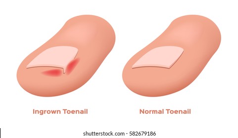 Ingrown Toenail Vector