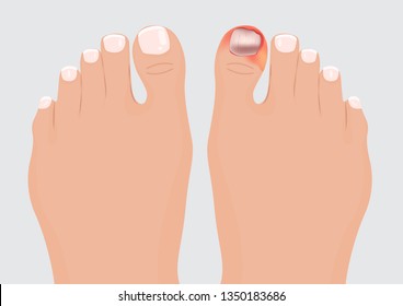 Ingrown Toenail Vector Illustration